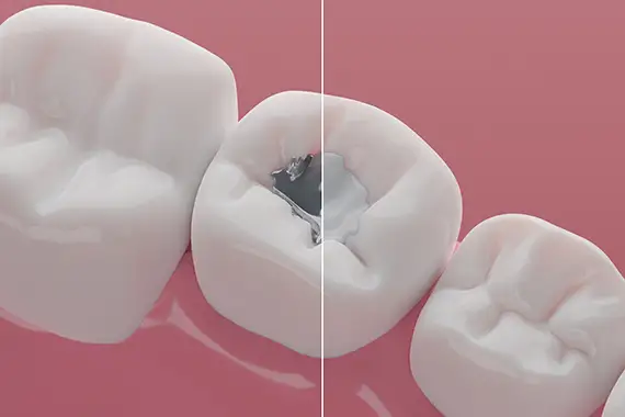 Amalgam / Silver Filling Removal and Replacement