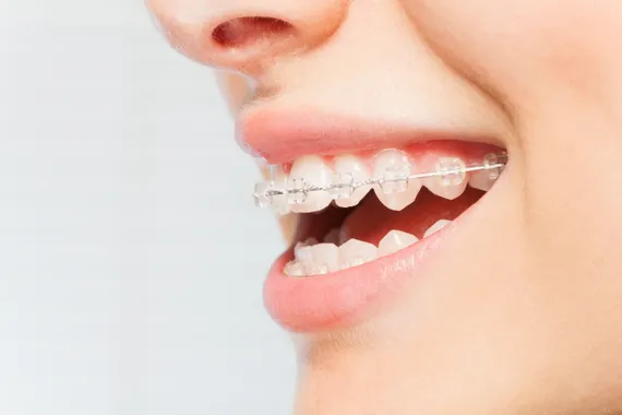 Person smiling with visibly misaligned teeth, representing orthodontic needs.