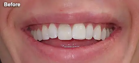 Before & After Smile