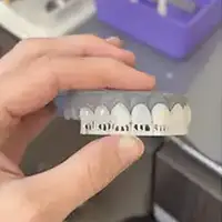 Smile Trial Veneers