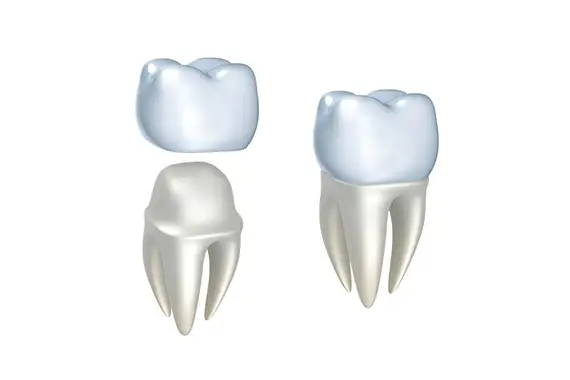 Ceramic dental crown being fabricated with advanced technology.