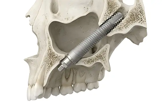 Dental implant