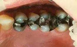 Crowns Before & After
