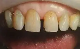 Veneers Before & After