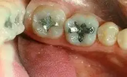 Crowns Before & After