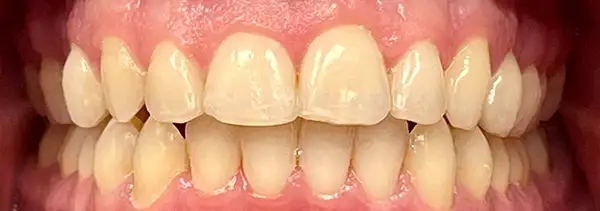 Invisalign Before & After Smile Gallery