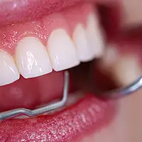 Periodontal Cleanings