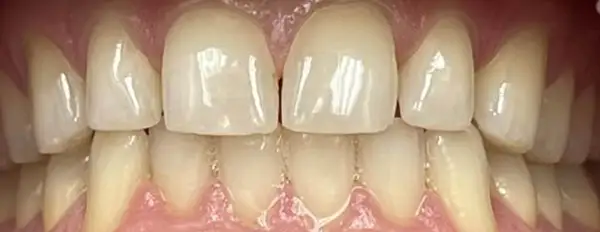 Invisalign Before & After Smile Gallery