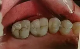 Ceramic Inlays & Onlays Before & After Smile Gallery