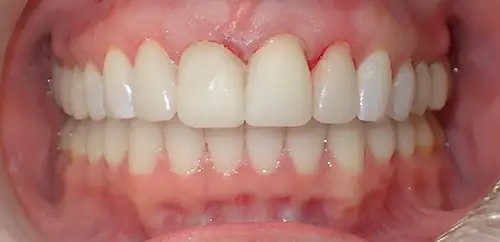 Temporary Smile and Bite