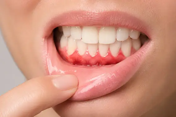 Non-invasive periodontal tray therapy