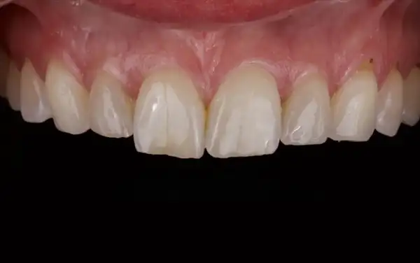 Before and After