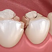Tooth Fracture Treatment