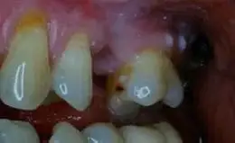 Bridges Before & After Smile Gallery 