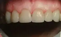 Veneers Before & After