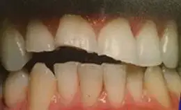 Veneers Before & After