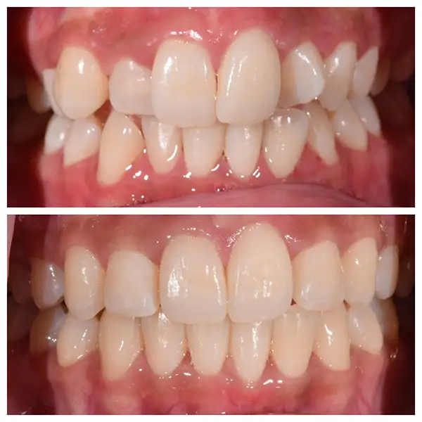 Invisalign Treatment Before & After