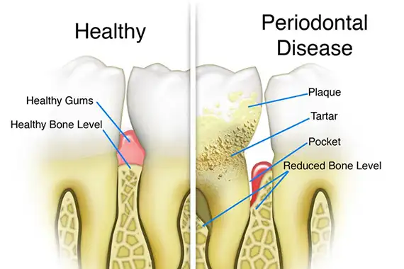 Periodontal maintenance