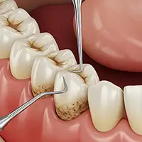 Scaling and Root Planing (Deep Cleaning)