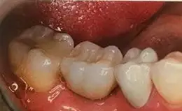 Dental Implants Before & After