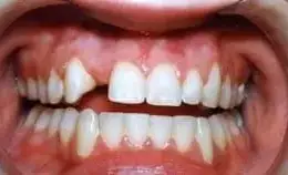 Dental Implants Before & After