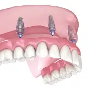 Implant-Supported Dentures