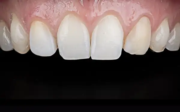 Before and After