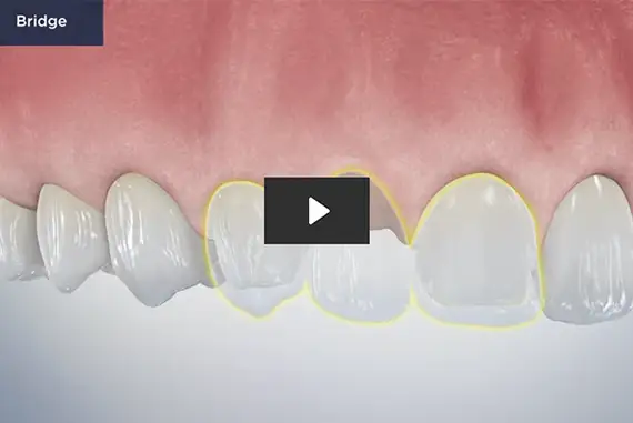Dental bridge with artificial teeth and supportive crowns.