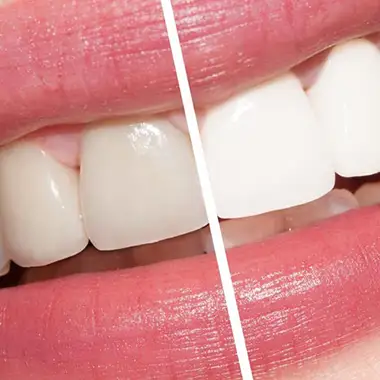 In-office Zoom Whitening