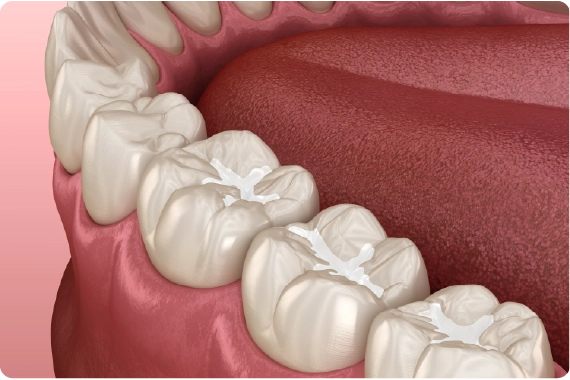 Dental fillings
