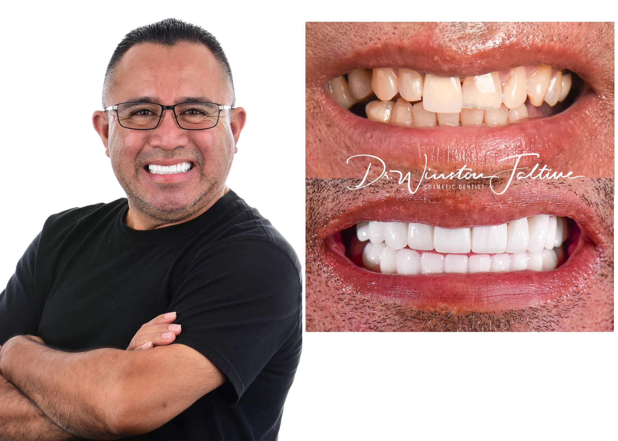 A before-and-after style split image showing two moments of the same patient: on one side, a person with a hesitant, closed-mouth expression, and on the other, the same person laughing openly with a beautifully transformed smile in a bright, welcoming dental office setting.