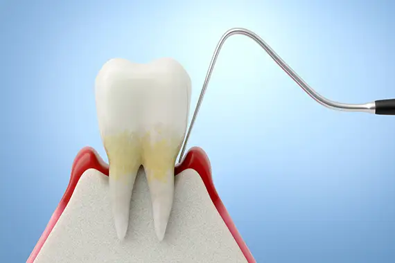 Scaling and root planing