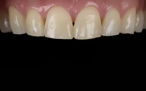Before and After