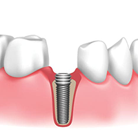 Guided implant placement
