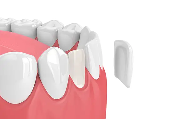 Veneers result