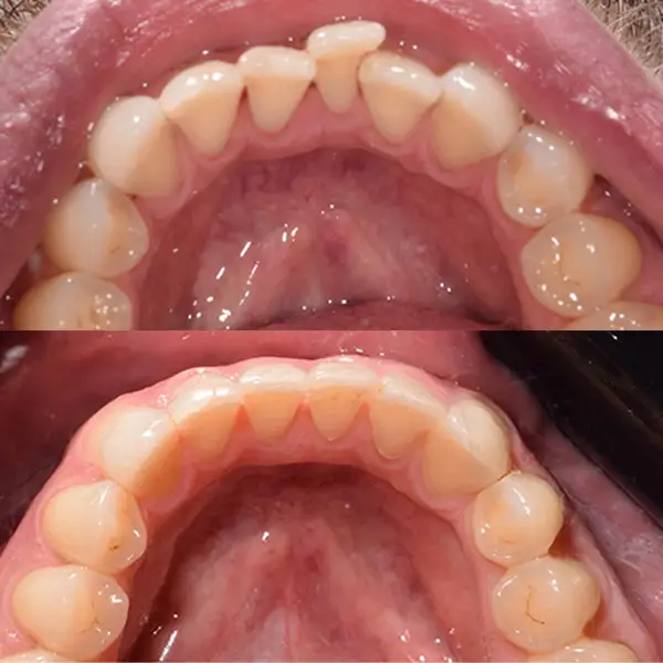 Invisalign Treatment Before & After