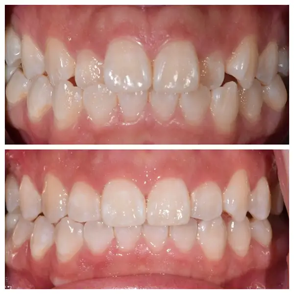 Invisalign Treatment Before & After