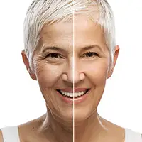 Anti-Wrinkle Botox