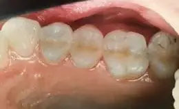 Ceramic Inlays & Onlays Before & After Smile Gallery