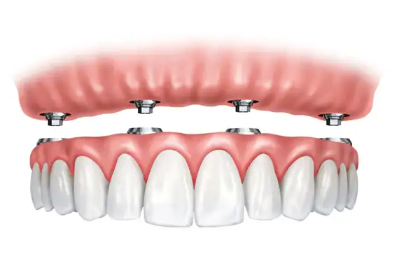 Overdentures