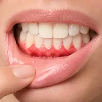 Perio Tray Therapy