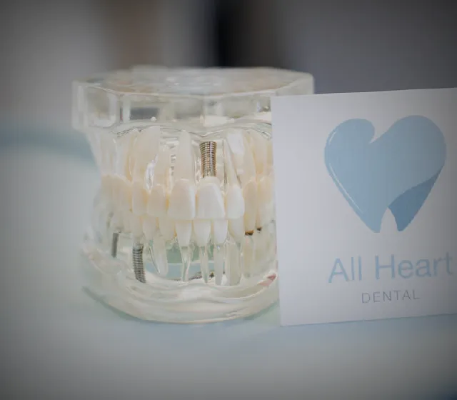 A close-up of a dental implant model on a clean white surface in a modern dental setting, illustrating the precision and quality of implant restorations.