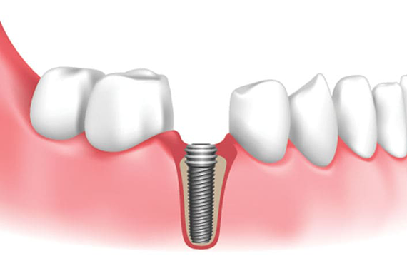 Guided Implant Placements