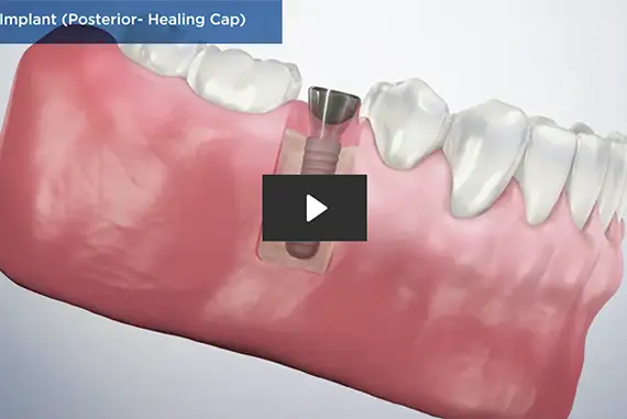 Dental implant showcasing advanced technology and high-grade materials.