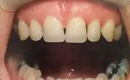 Veneers Before & After