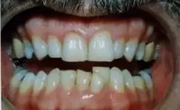 Whitening Before & After Smile Gallery