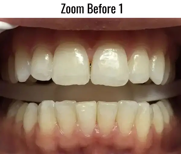 Zoom Before 1