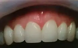 Veneers Before & After