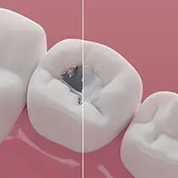 Amalgam / Silver Filling Removal and Replacement