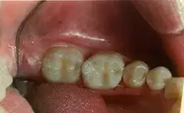 Crowns Before & After
